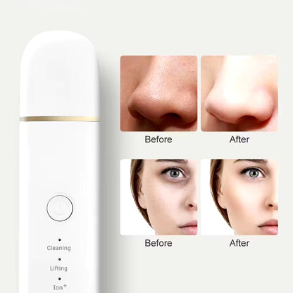 Ultrasonic Blackhead Remover