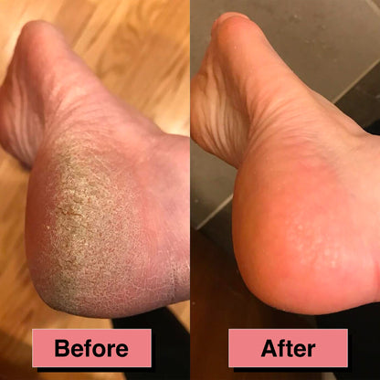 Electric callus remover